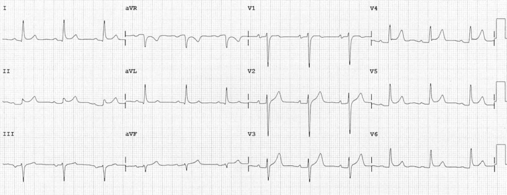 12-lead ECG showing diffuse ST elevation and PR depression in acute pericarditis
