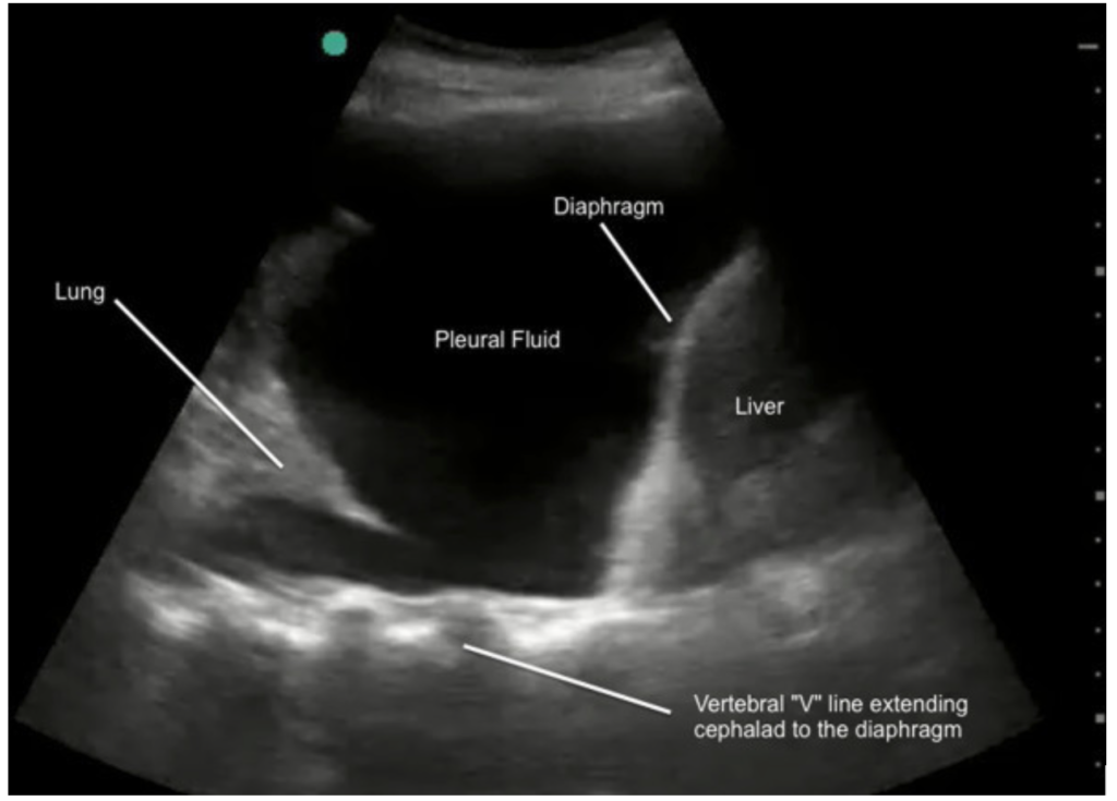 Lung ultrasound showing bilateral pleural effusions with atelectatic lung and the spine sign