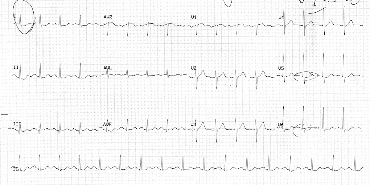 NSTEMI ECG showing ST depression and T-wave inversion &mdash; view on LITFL