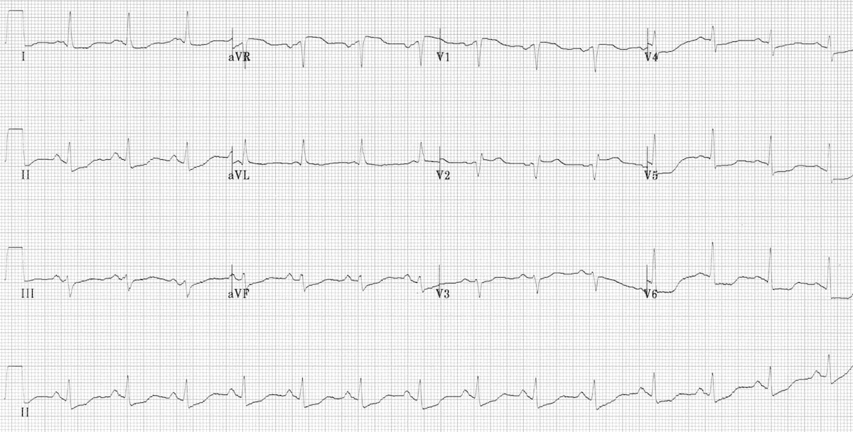 STEMI ECG showing ST elevation &mdash; view on LITFL