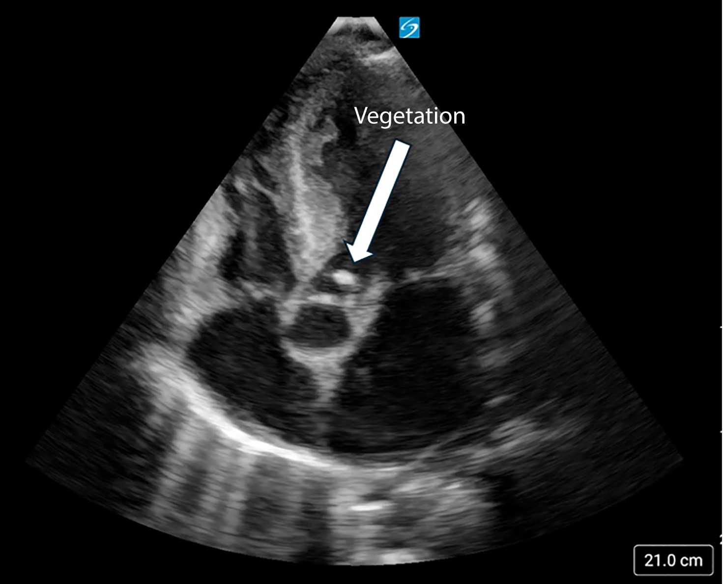 POCUS parasternal long axis view showing aortic valve vegetation (arrow)